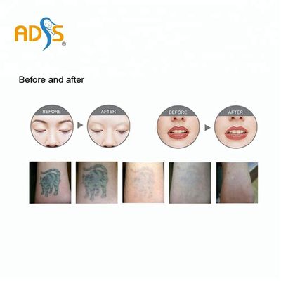 Máy Laser ND YAG xung dài Máy loại bỏ sắc tố bằng laser 1064nm