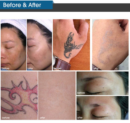 Máy Laser Picosecond làm đẹp dọc Máy loại bỏ sắc tố Laser